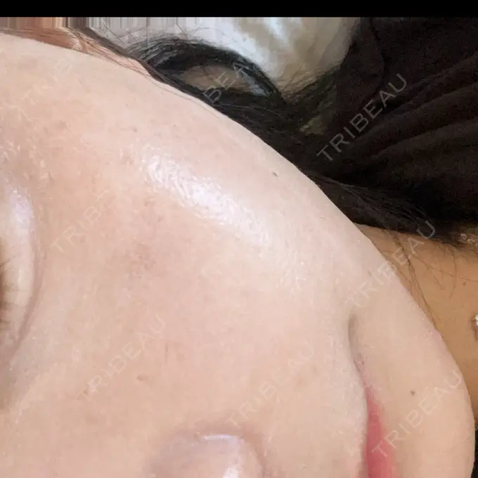 ヒアルロン酸注入（涙袋） アリエル美容クリニック 水戸院 DAY 3 メイン用