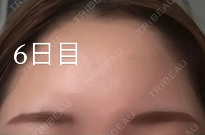 アートメイク（眉） メディカルアートメイク大阪 DAY 32 メイン用