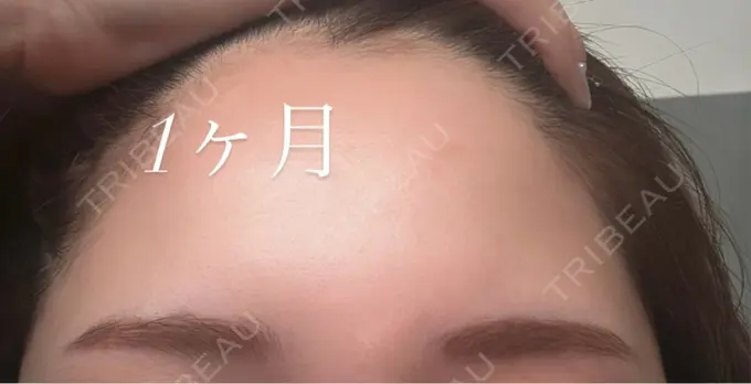 アートメイク（眉） メディカルアートメイク大阪 DAY 32 メイン用