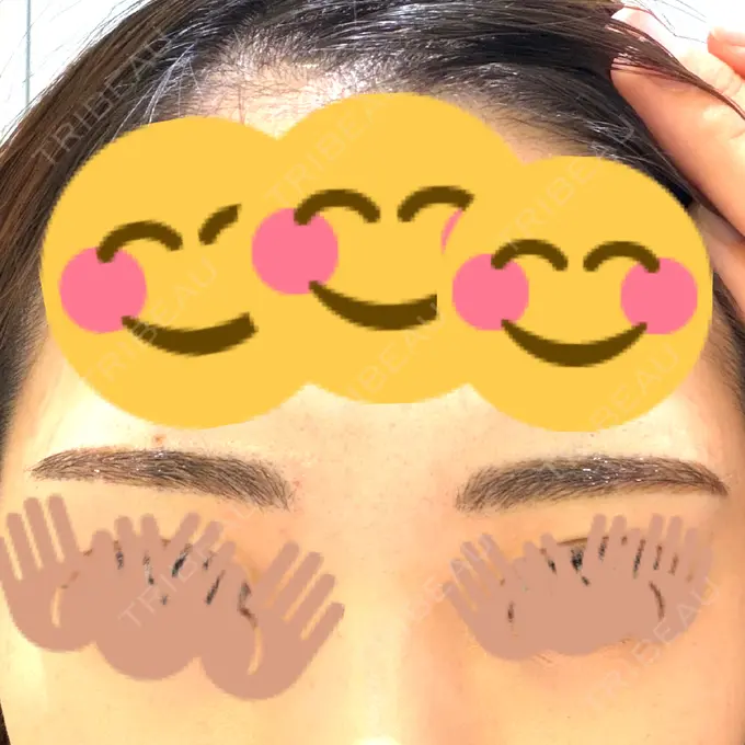 ボトックス（眉間） / アートメイク（眉） グランヴォーテ DAY 171 メイン用