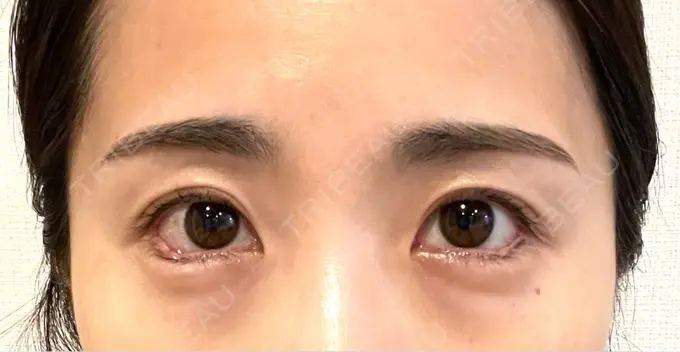 目尻切開 / タレ目形成・グラマラスライン（埋没） LOUIS CLINIC 二子玉川院【ルイクリニック】 DAY 4 メイン用