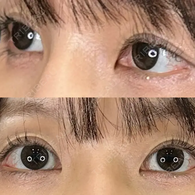 クマ治療 / 下まぶたの脂肪取り / 脂肪注入（目の下） / ボトックス（額） 藤・ナチュレ美容クリニック 銀座院 AFTER メイン用