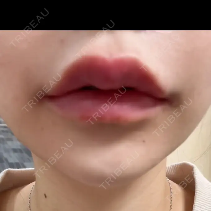 ヒアルロン酸注入（唇） NARU Beauty Clinic 【ナルクリ】 水戸院 DAY 0 メイン用