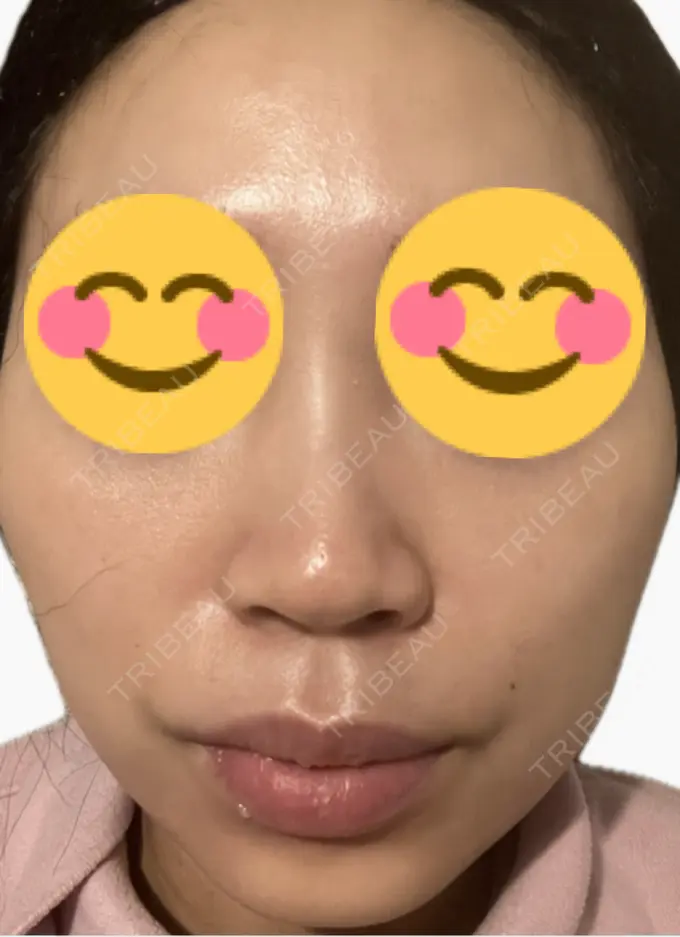 プラセンタ注射 美容皮膚科エルムクリニック 麻布院 AFTER メイン用