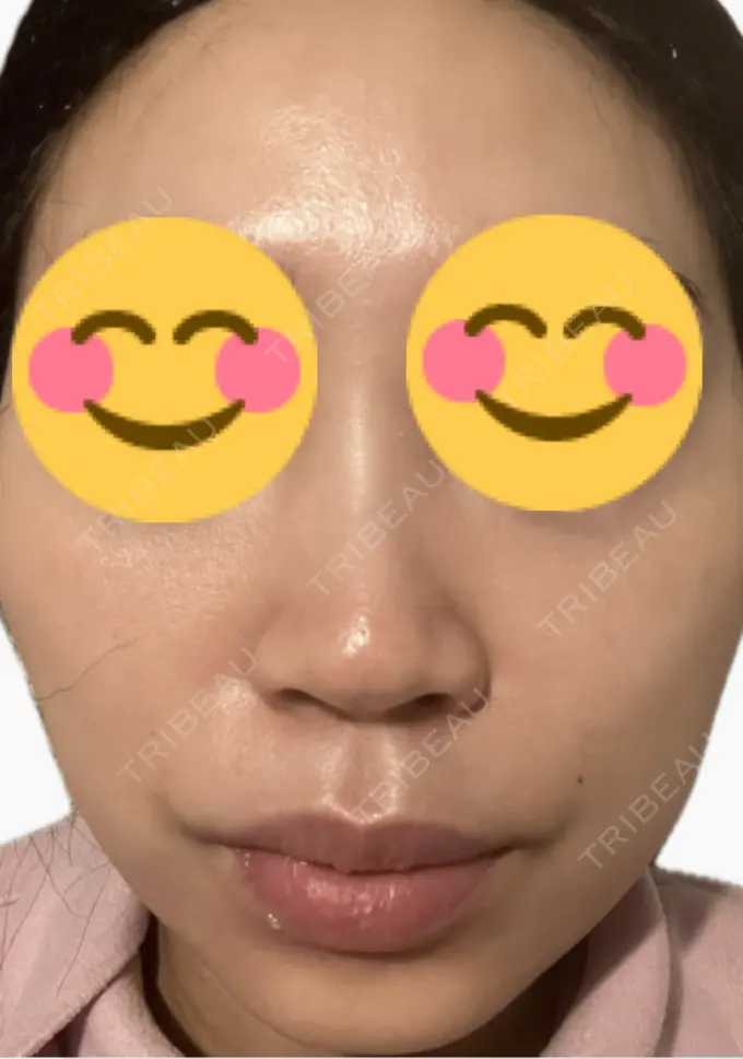 医療脱毛（顔） タイムルクリニック DAY 3 メイン用