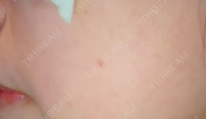 ほくろ・いぼ切除（肌） 札幌中央クリニック DAY 18 メイン用