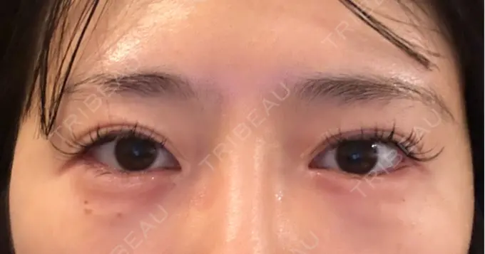 ヒアルロン酸注入（涙袋） ネビュラクリニック 東京錦糸町院 AFTER メイン用