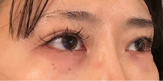 ヒアルロン酸注入（涙袋） ネビュラクリニック 東京錦糸町院 DAY 0 メイン用