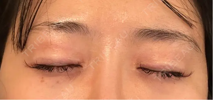 ヒアルロン酸注入（涙袋） ネビュラクリニック 東京錦糸町院 DAY 0 メイン用