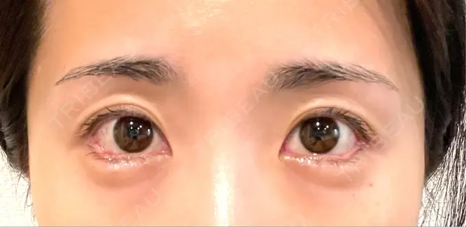 目尻切開 / タレ目形成・グラマラスライン（埋没） LOUIS CLINIC 二子玉川院【ルイクリニック】 DAY 5 メイン用