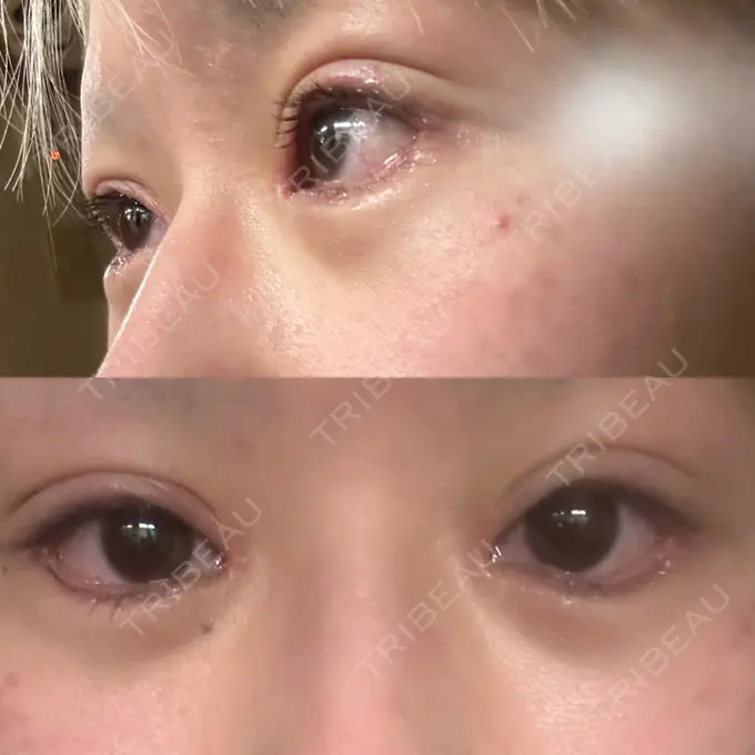 二重埋没 / 目頭切開 / クマ治療 / 目尻切開 / タレ目形成・グラマラスライン（切開） / 目尻靭帯移動 エターナル美容クリニック DAY 14 メイン用