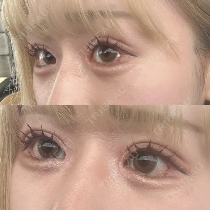 二重埋没 / 目頭切開 / クマ治療 / 目尻切開 / タレ目形成・グラマラスライン（切開） / 目尻靭帯移動 エターナル美容クリニック DAY 14 メイン用