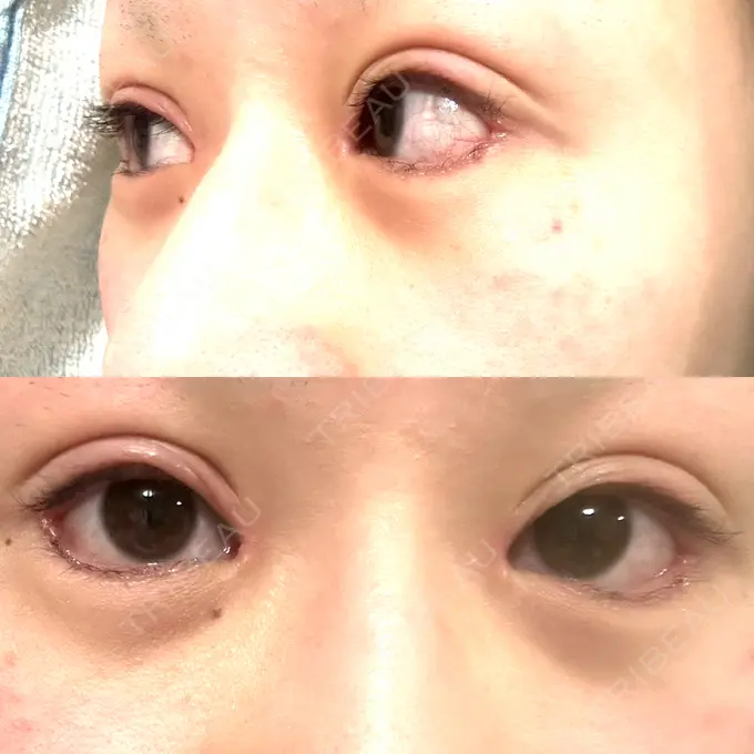 二重埋没 / 目頭切開 / クマ治療 / 目尻切開 / タレ目形成・グラマラスライン（切開） / 目尻靭帯移動 エターナル美容クリニック DAY 15 メイン用