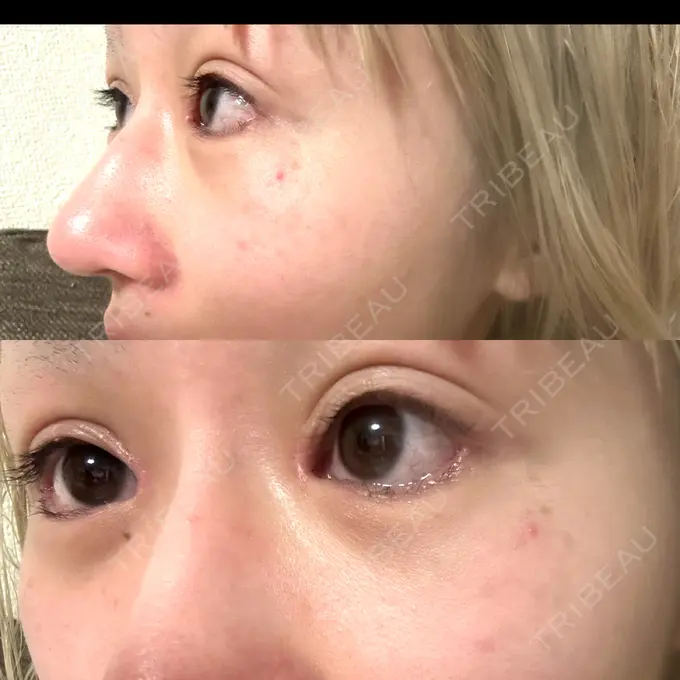 二重埋没 / 目頭切開 / クマ治療 / 目尻切開 / タレ目形成・グラマラスライン（切開） / 目尻靭帯移動 エターナル美容クリニック DAY 19 メイン用