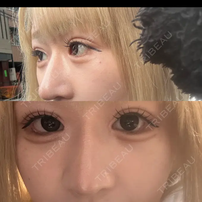 二重埋没 / 目頭切開 / クマ治療 / 目尻切開 / タレ目形成・グラマラスライン（切開） / 目尻靭帯移動 エターナル美容クリニック DAY 19 メイン用