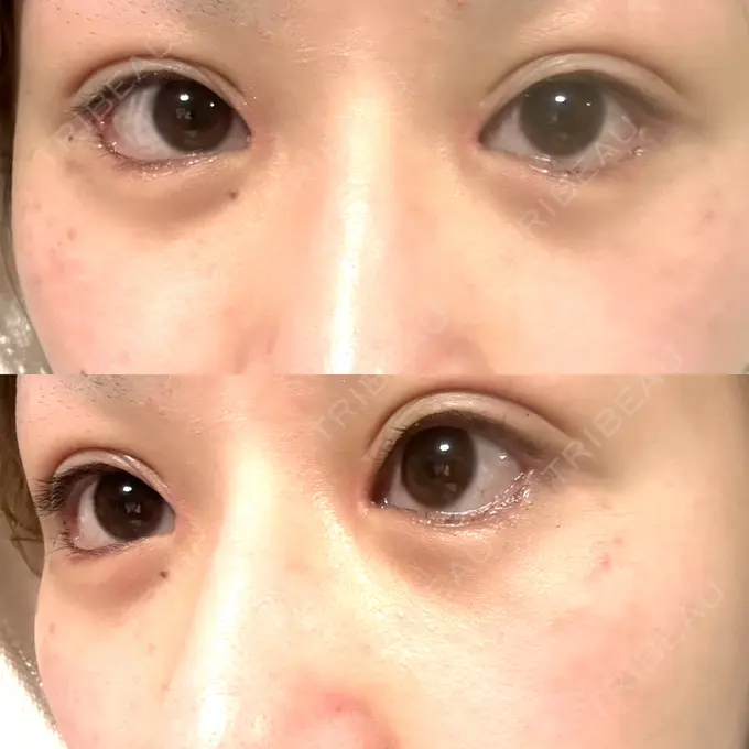 二重埋没 / 目頭切開 / クマ治療 / 目尻切開 / タレ目形成・グラマラスライン（切開） / 目尻靭帯移動 エターナル美容クリニック DAY 21 メイン用