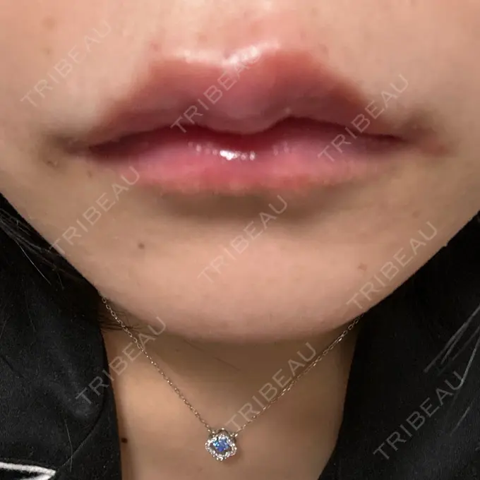 ヒアルロン酸注入（唇） NARU Beauty Clinic 【ナルクリ】 水戸院 DAY 1 メイン用