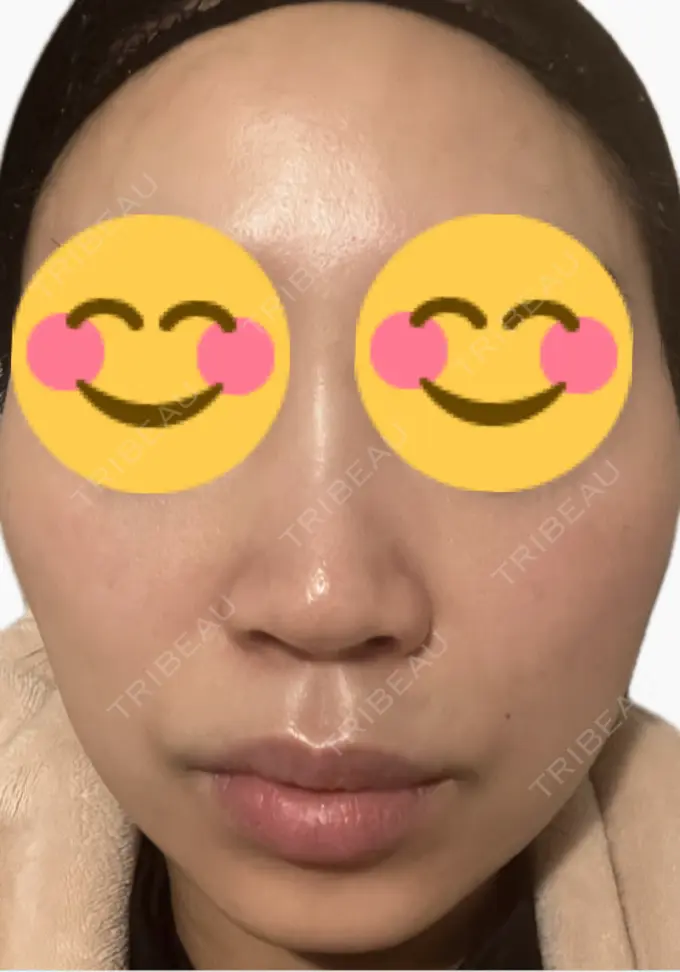 医療脱毛（顔） タイムルクリニック DAY 4 メイン用