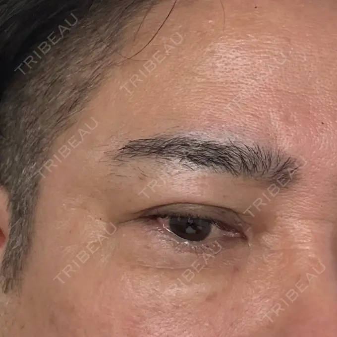 水光注射（ハリ・美肌） Natural Skin Clinic 笹塚院 DAY 3 メイン用