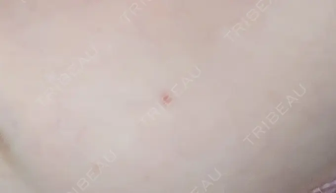 ほくろ・いぼ切除（肌） 札幌中央クリニック AFTER メイン用