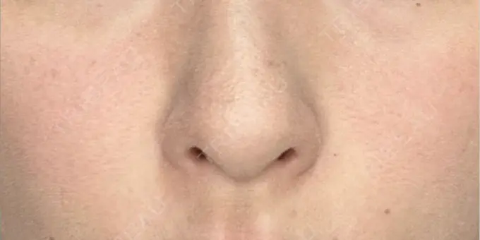 肌ヒアルロン酸注入（たるみ・シワ改善） NARU Beauty Clinic 【ナルクリ】 水戸院 DAY 0 メイン用