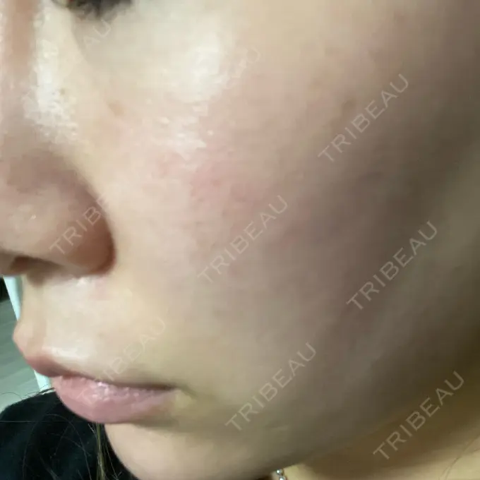 その他（肌） / 医療脱毛（顔） さっぽろ美容クリニック DAY 0 メイン用