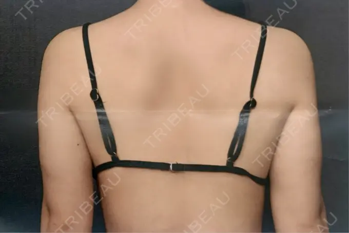 脂肪吸引（二の腕） / 脂肪吸引（肩） THE CLINIC（ザ・クリニック） 福岡院 AFTER メイン用