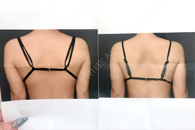 脂肪吸引（二の腕） / 脂肪吸引（肩） THE CLINIC（ザ・クリニック） 福岡院 DAY 192 メイン用