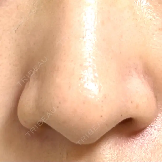 毛穴洗浄（ハイドラフェイシャルなど） 日本美容・医療クリニック 六本木院 AFTER メイン用