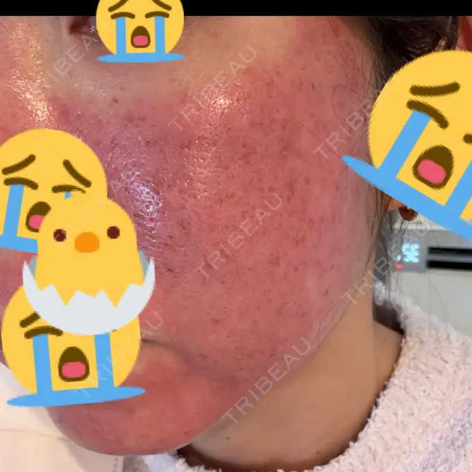 ルビーレーザー AZ BEAUTY CLINIC DAY 0 メイン用