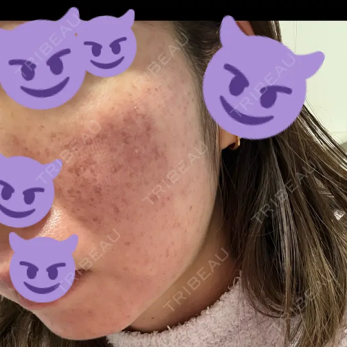 ルビーレーザー AZ BEAUTY CLINIC DAY 1 メイン用