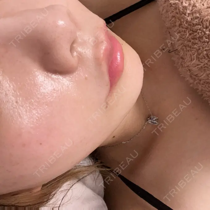 ヒアルロン酸注入（涙袋） アリエル美容クリニック 水戸院 DAY 6 メイン用