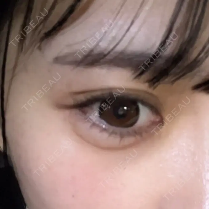 ヒアルロン酸注入（涙袋） アリエル美容クリニック 水戸院 DAY 6 メイン用