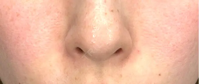 肌ヒアルロン酸注入（たるみ・シワ改善） NARU Beauty Clinic 【ナルクリ】 水戸院 DAY 0 メイン用