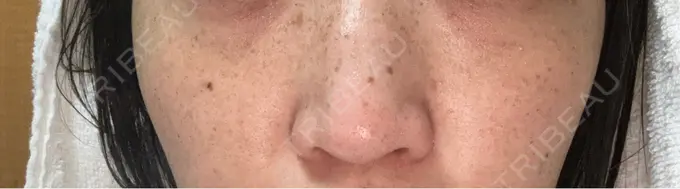 ルメッカ ルラ美容クリニック 名古屋栄院 / ルラスキンクリニック 名古屋栄院 DAY 7 メイン用