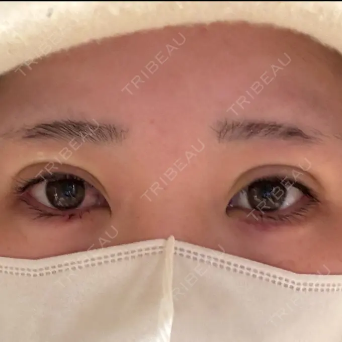 二重埋没 / ヒアルロン酸注入（涙袋） 恵聖会クリニック 京橋院 DAY 0 メイン用