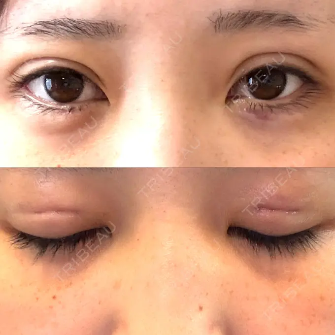 二重埋没 / ヒアルロン酸注入（涙袋） 恵聖会クリニック 京橋院 DAY 0 メイン用