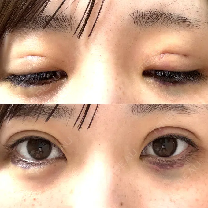 二重埋没 / ヒアルロン酸注入（涙袋） 恵聖会クリニック 京橋院 DAY 2 メイン用