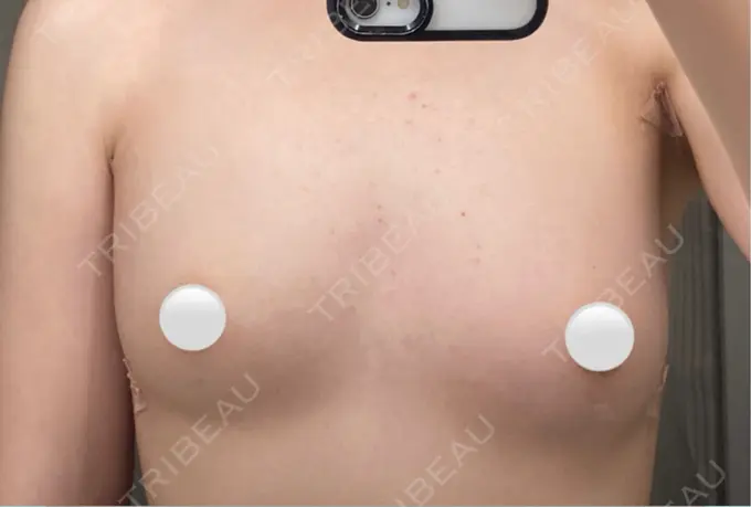 豊胸（脂肪注入） ルーチェクリニック 銀座院 DAY 28 メイン用