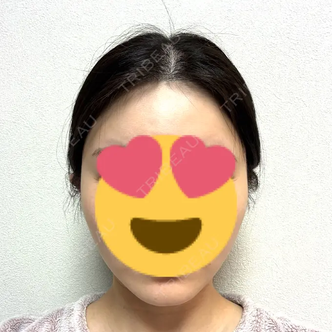 糸リフト / バッカルファット除去 / 脂肪吸引（顔） / 脂肪吸引（二の腕） / ジョールファット除去 / 脂肪吸引（肩） / 脂肪注入（輪郭） First Clinic AFTER メイン用