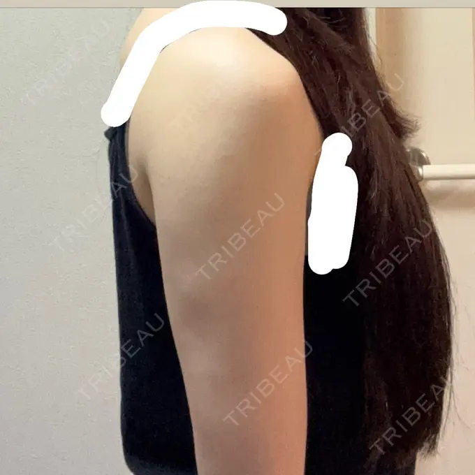 糸リフト / バッカルファット除去 / 脂肪吸引（顔） / 脂肪吸引（二の腕） / ジョールファット除去 / 脂肪吸引（肩） / 脂肪注入（輪郭） First Clinic DAY 91 メイン用