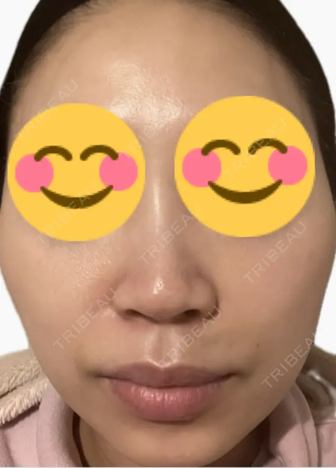 医療脱毛（顔） タイムルクリニック DAY 5 メイン用