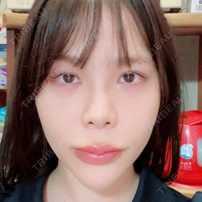 ボトックス（口角） / ヒアルロン酸注入（頬） おおたかの森ビューティークリニック DAY 9 メイン用