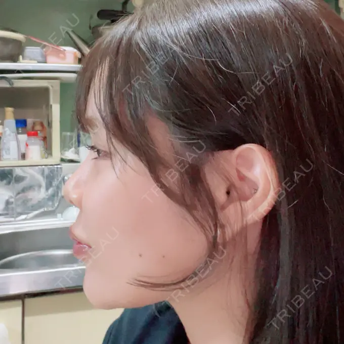 ボトックス（口角） / ヒアルロン酸注入（頬） おおたかの森ビューティークリニック DAY 9 メイン用