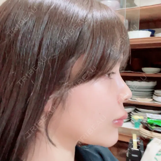 ボトックス（口角） / ヒアルロン酸注入（頬） おおたかの森ビューティークリニック DAY 9 メイン用