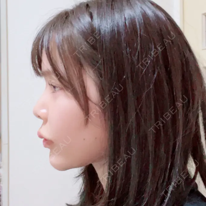 ボトックス（口角） / ヒアルロン酸注入（頬） おおたかの森ビューティークリニック DAY 10 メイン用