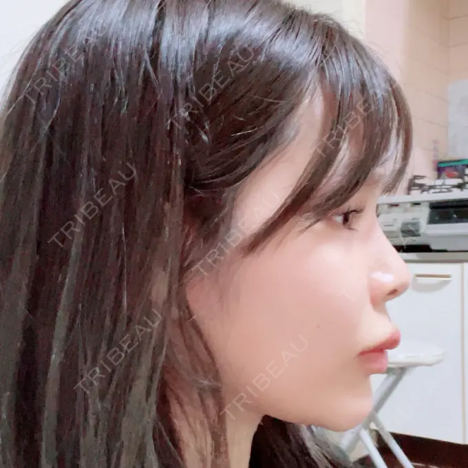 ボトックス（口角） / ヒアルロン酸注入（頬） おおたかの森ビューティークリニック DAY 10 メイン用