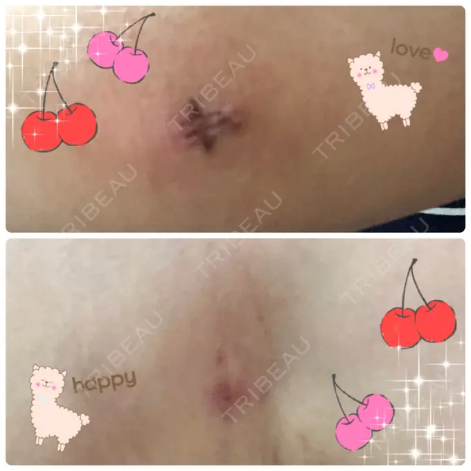 脂肪吸引（二の腕） ヨンセスリムライン DAY 13 メイン用