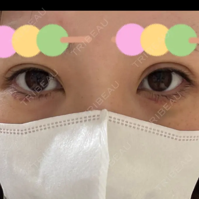 二重埋没 / ヒアルロン酸注入（涙袋） 恵聖会クリニック 京橋院 DAY 9 メイン用