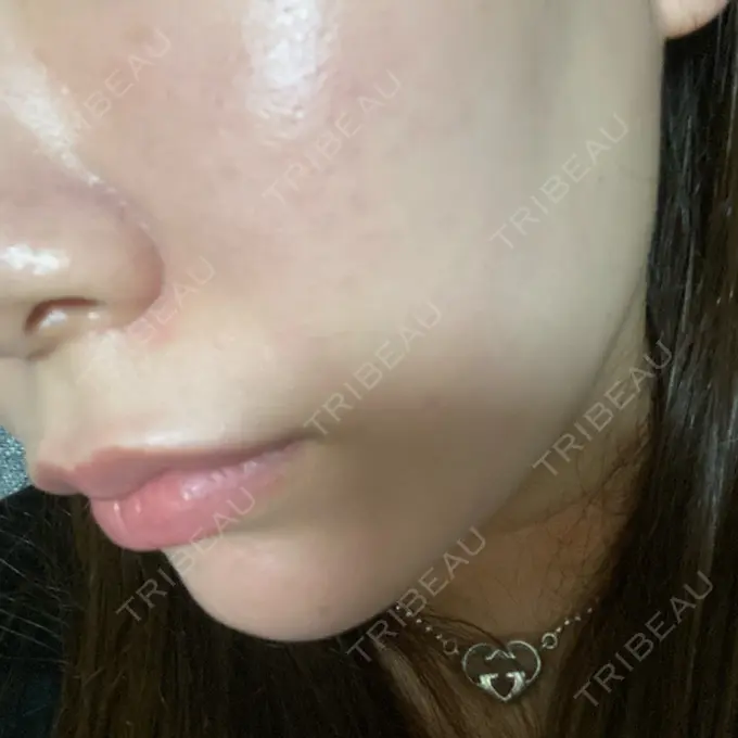 その他（肌） / 医療脱毛（顔） さっぽろ美容クリニック DAY 1 メイン用